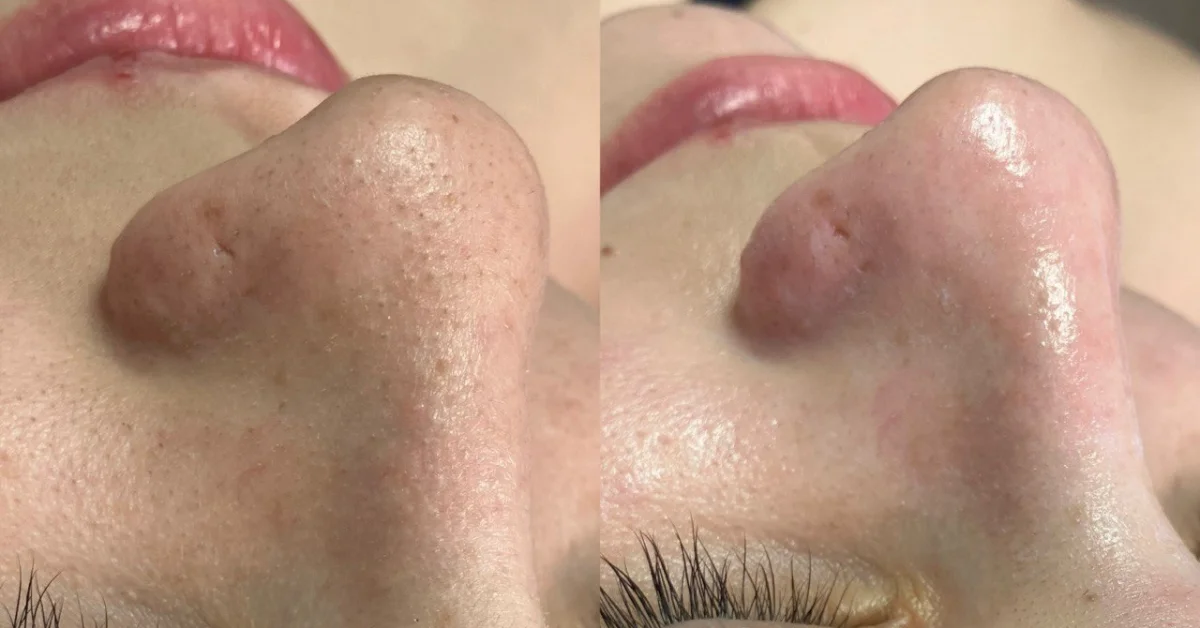 antes-e-depois-limpeza-de-pele-amat-estetica-porto