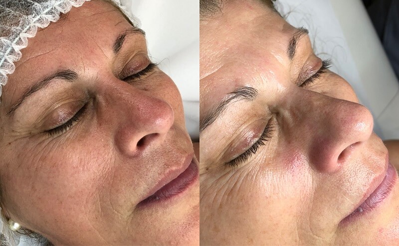 limpeza-de-pele-antes-e-depois