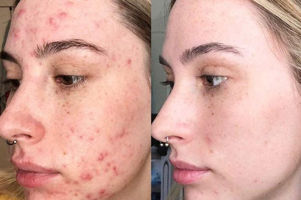 peeling-quimico-para-acne
